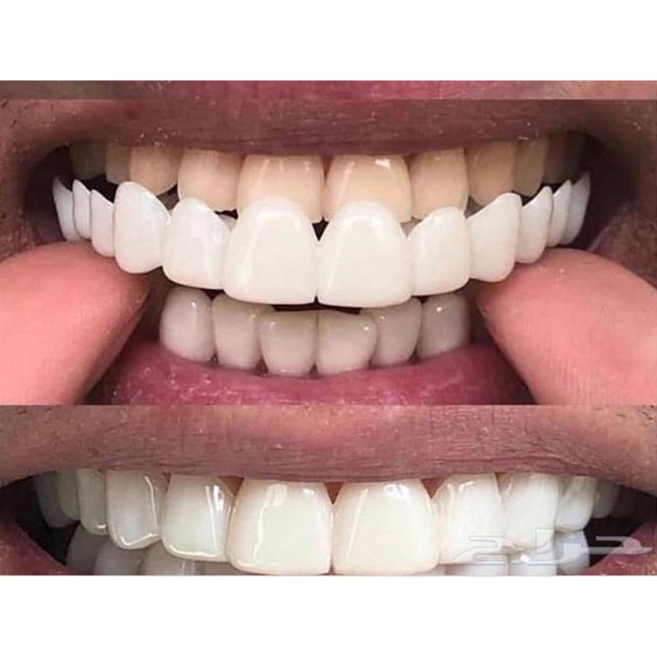 IMPORTED Snap-On Teeth Veneers